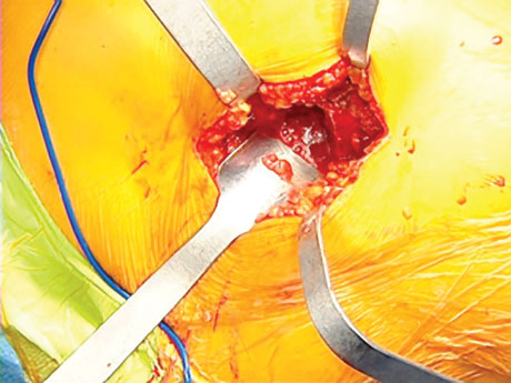 Dorr Hip Instruments