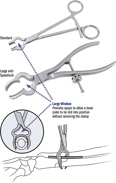 Durham Bone Reduction Clamp