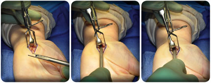 Hagan Carpal Tunnel Release Sleeve