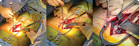 Harvey Lumbar Bone Graft Sled Assembly