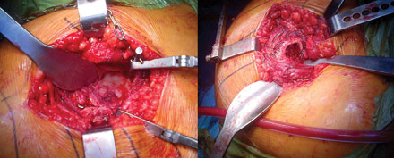 Harwin Modified Cobra Retractor