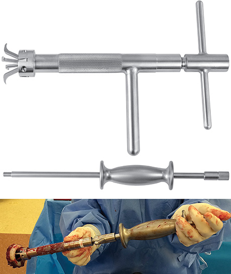 Lombardi Hip Cup Liner/Shell Extractor