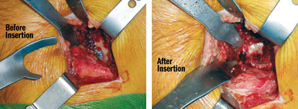 Moran Posterior-Inferior Retractor