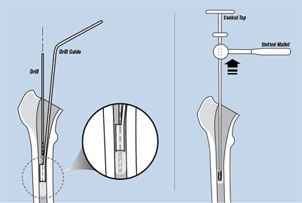 Mueller-Type Cement Removal Instruments