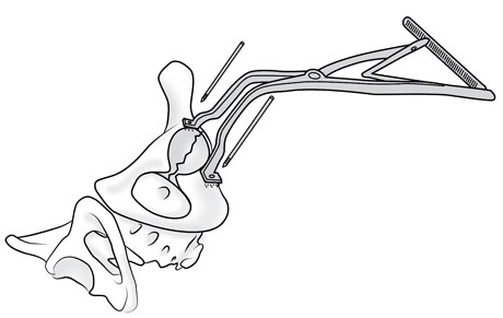 Paprosky Acetabular Spreader