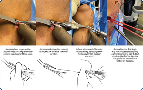 Rose Hamstring Tendon Harvester