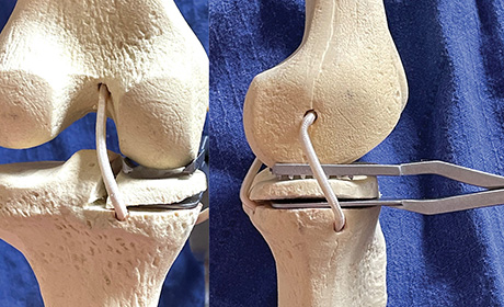 Rosenstein Forked UKA Tibial Fragment Grasper
