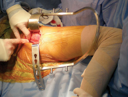 Charnley/Sorrells Low-Profile Hip Arthroplasty Retractor System