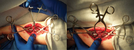 Stanton Articulating Small Bone Clamps