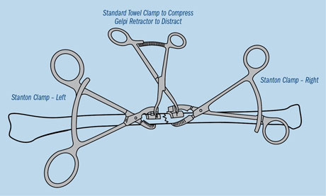 Stanton Articulating Small Bone Clamps