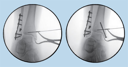 Teurlings Medial Malleolar Clamp