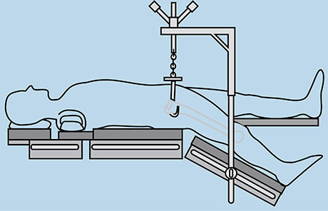 Wixson Anterior Suspension Hook System