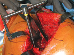 Amstutz Charnley-type Acetabular Exposure Pin Set