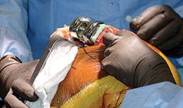 Booth Knee Retractor