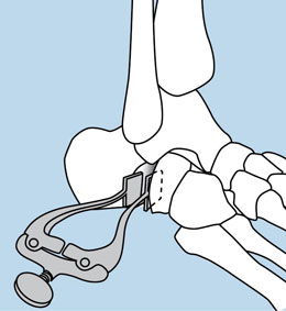 Calcaneal Lateral Column Spreader