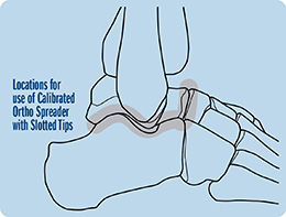 Calibrated Ortho Spreader with Slotted Tips