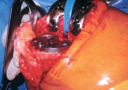 PCL Retractors