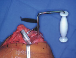 Distal Femur Distractor
