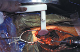 Dozier Radiolucent Bennett Hip Fracture Retractor