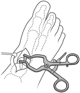 HFD Self-Retaining Small Bone Spreader