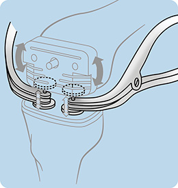 Lawrence Revision Knee Gap Balancing Tensioner Set