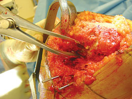 Lombardi Femoral Tibial Spreaders