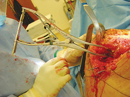 Lombardi Femoral Tibial Spreaders
