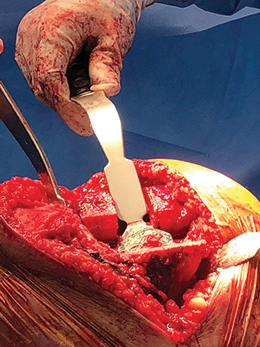 Manzary Proximal Tibial Stabilizing Knee Retractor