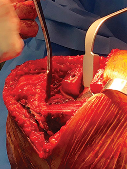 Manzary Proximal Tibial Stabilizing Knee Retractor