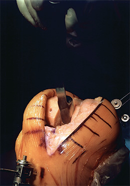 Meckel Posterior Stabilizing Knee Retractor