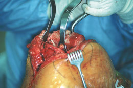Chandler Retractor