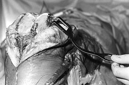 AORI Patellar Retractor