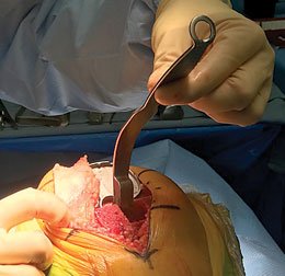 Rosen Knee Revision Tibial Retractor