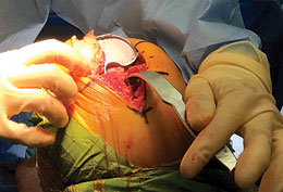 Rosen Knee Revision Tibial Retractor