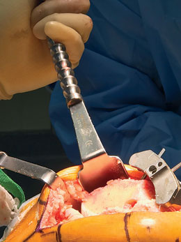 Rosen Double Ended Richardson/Richardson Retractor
