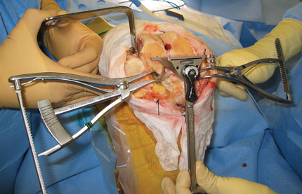 Scott Femoral Tibial Tensor/Spreader