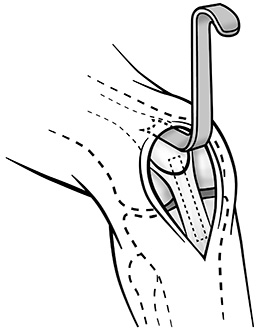 Sherman Patella Tendon Harvest Retractor