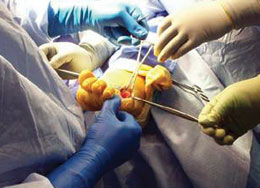 Slavitt Phalangeal Forceps