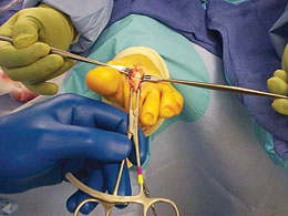 Slavitt Phalangeal Forceps