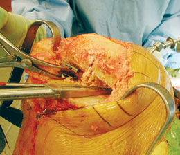 Calibrated Femoral Tibial Spreaders