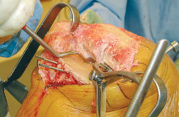 Calibrated Femoral Tibial Spreaders