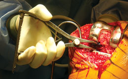 Calibrated Femoral Tibial Spreaders