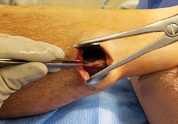Strayer Retractor