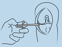Uni Medial/Lateral Ligament Retractor