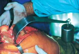 Wide PCL Retractor