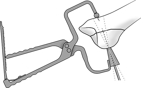 Boutefnouchet Periarticular Clamp