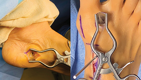 Monaco Small Space Retractor